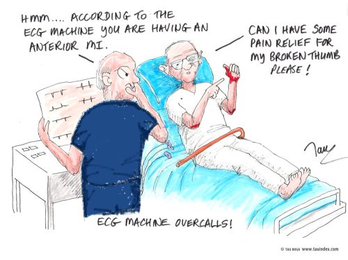 ECG-overcalls-Tau-Boga